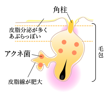 思春期ニキビ